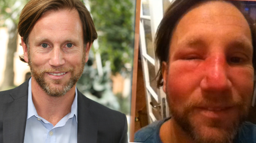 TV4,  Finne, Peter Jihde, Svullen, Bild, Ansikte