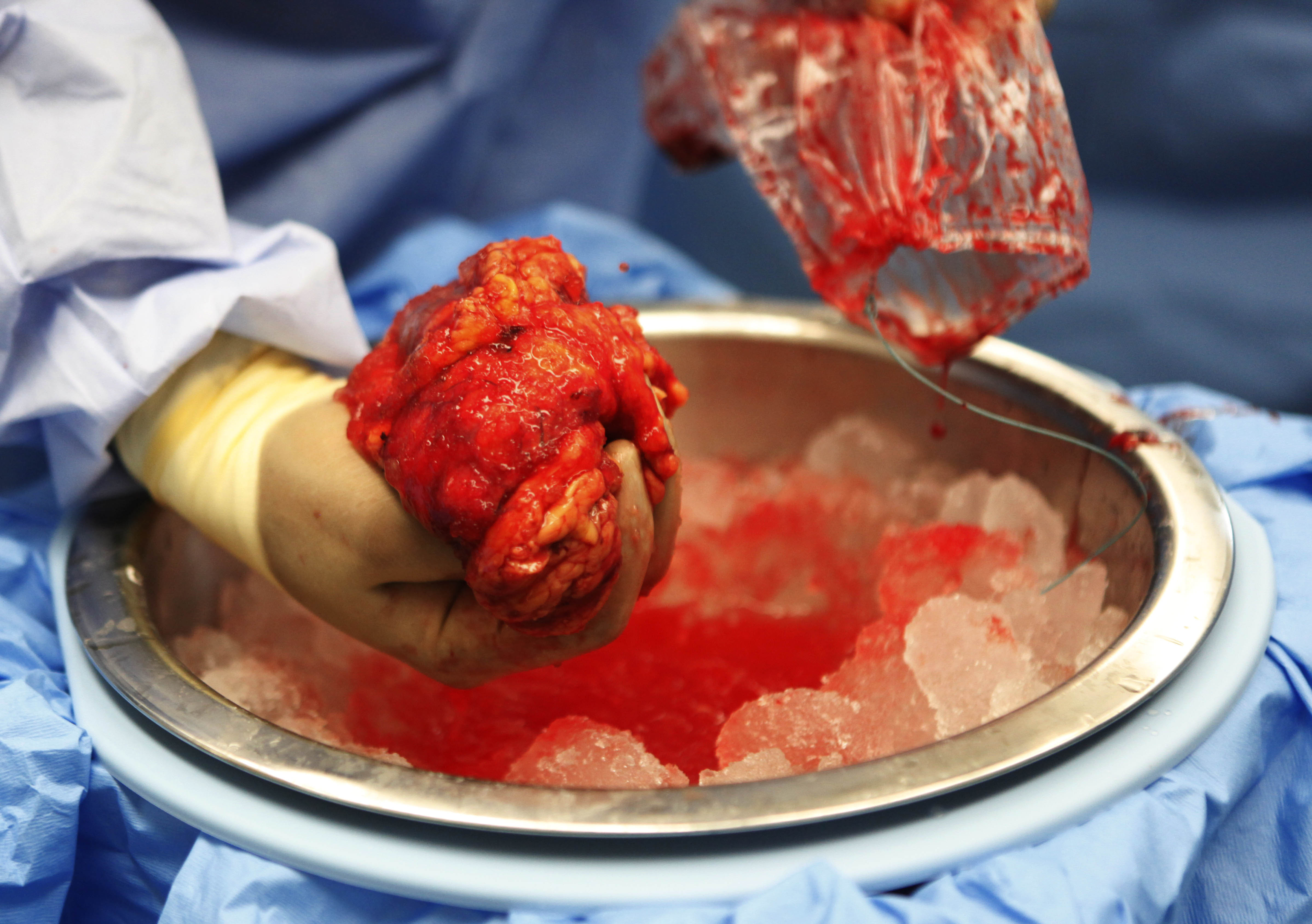 Njure, Teknik, Prylar, Transplantation, Organhandel, Ipad, Kina