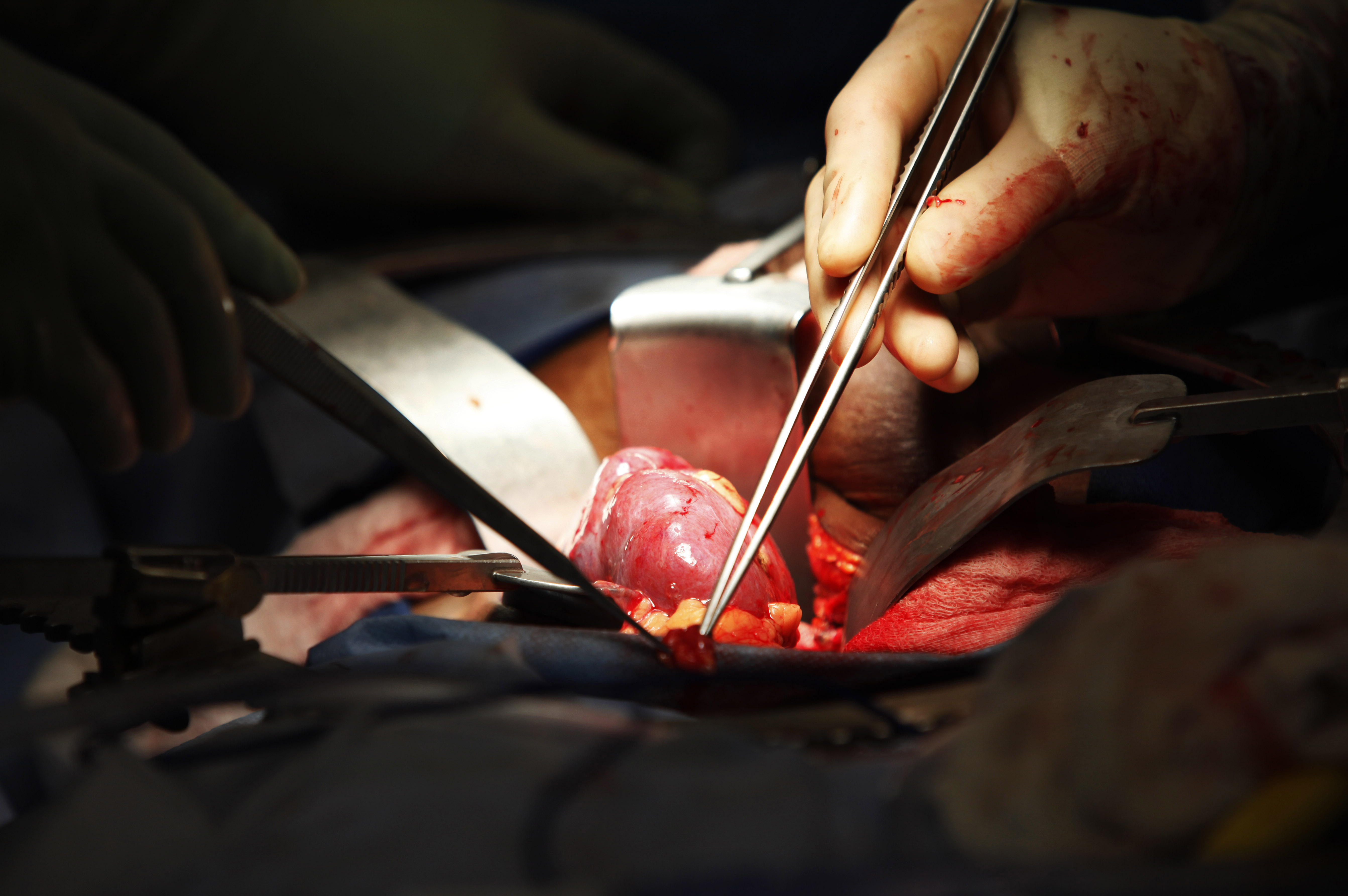 Organdonation, Lakare, Njure, Organ, Pengar, Organhandel