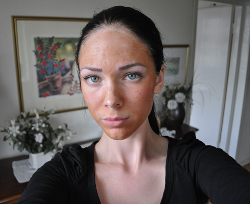 Vi-peel, Skin Care Academy, Ärr, Dagbok, Kemisk peeling