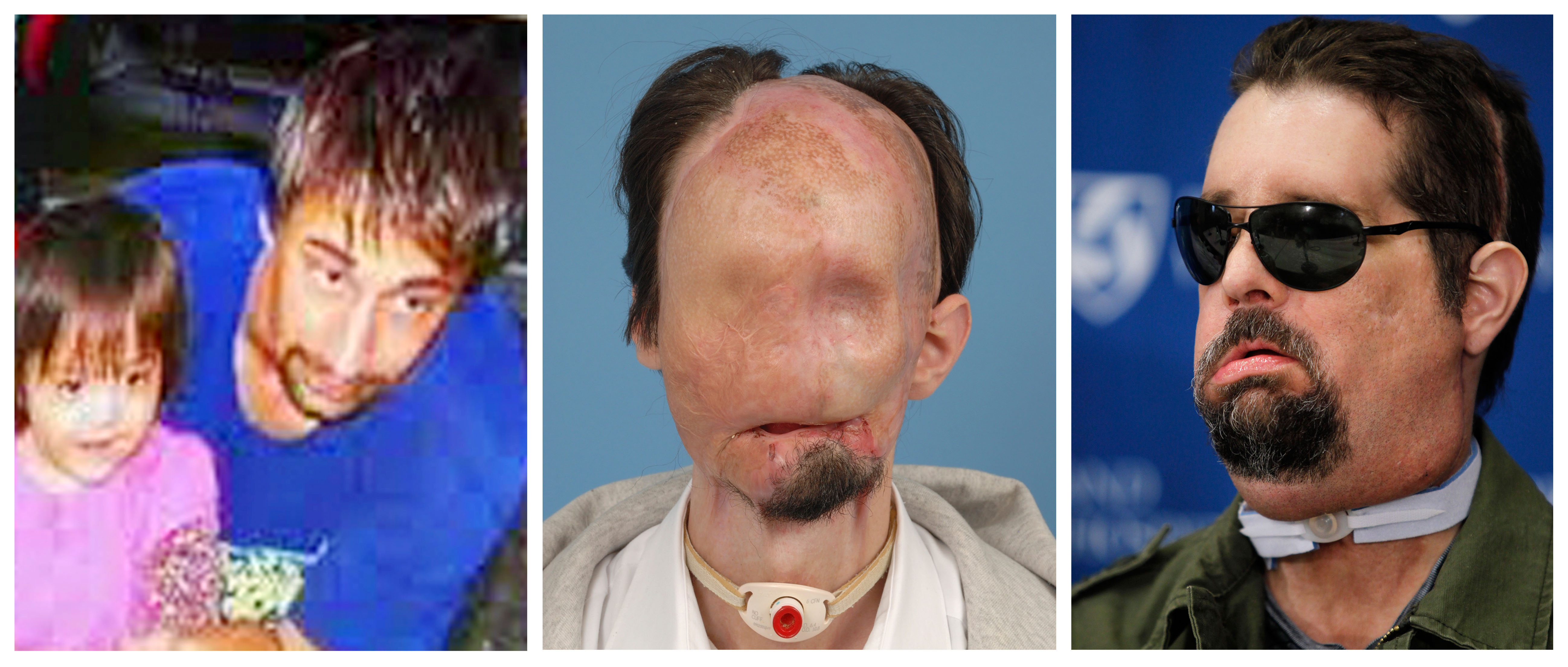 Ansikte, University of Maryland, Olycka, Skador, USA, Transplantationer