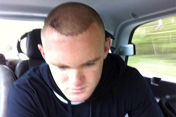 Hårtransplantation, Manchester United, Wayne Rooney