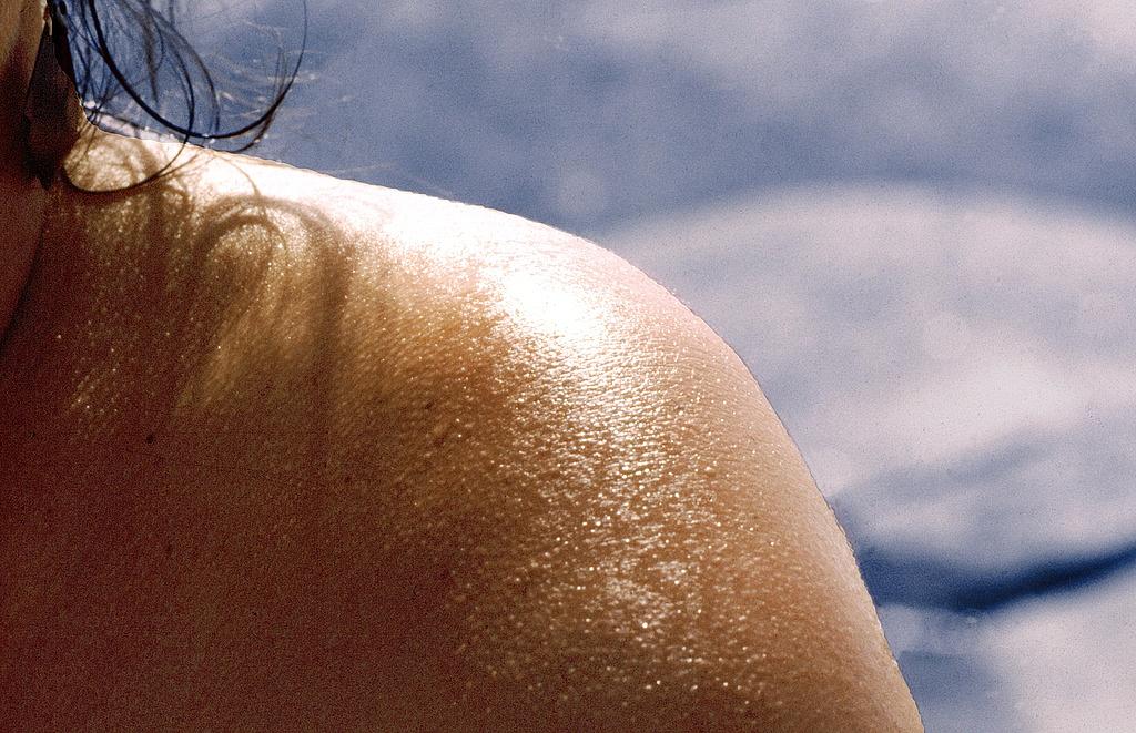 Bränna sig i solen Bränna sig i solen