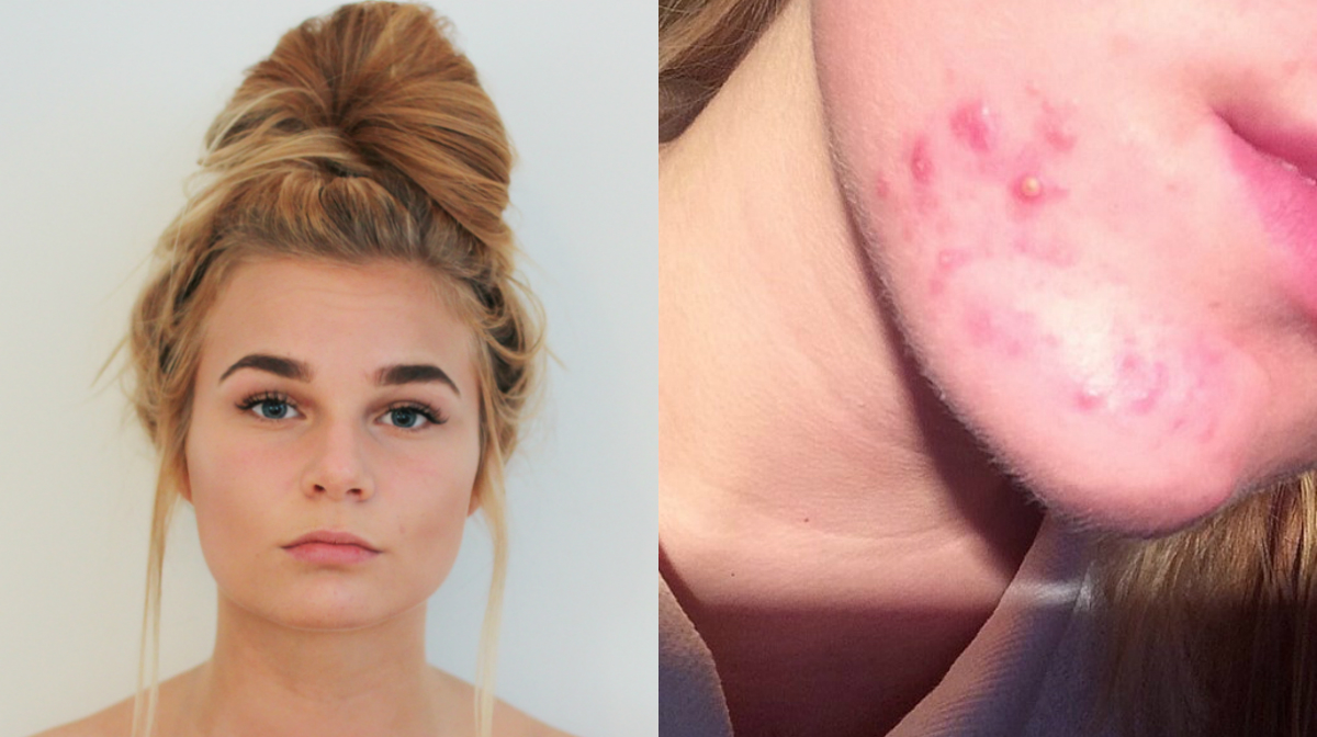 Malin Liljeroth skriver om sina upplevelser av acne.