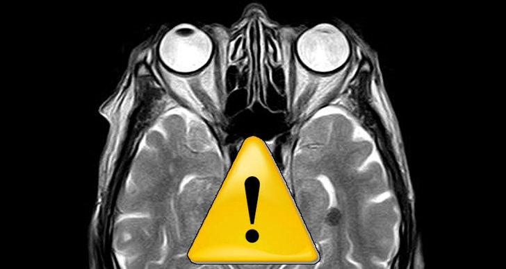 Hjärnan, fMRI, Forskning, Vetenskap, Universitet, Anders Eklund
