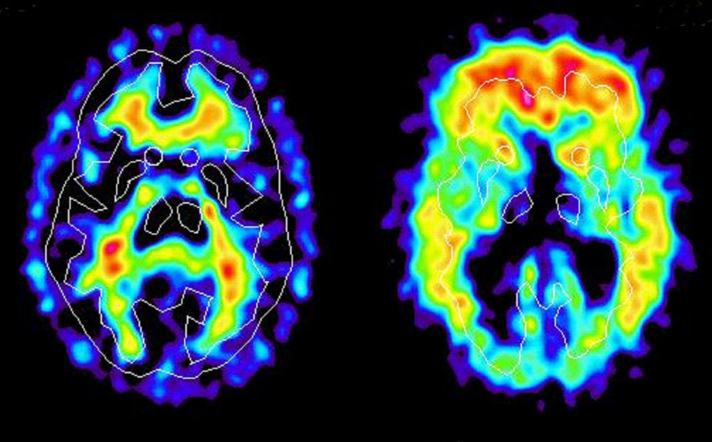 Bilden till vänster föreställer hjärnan hos en frisk person medan bilden till höger visar hjärnan hos en person drabbad av alzheimer.  