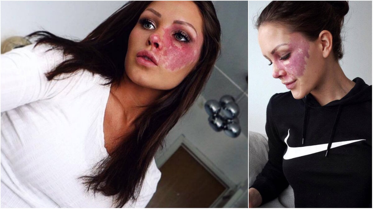 Marina Isaksson, 25, från Stockholm har under stora delar av sitt liv täckt över sitt födelsemärke i ansiktet. 