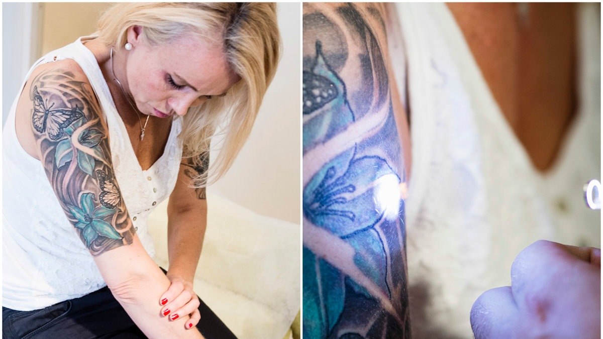 Färgen på en tatuering avgör hur enkelt den kan tas bort med laserbehandling.
