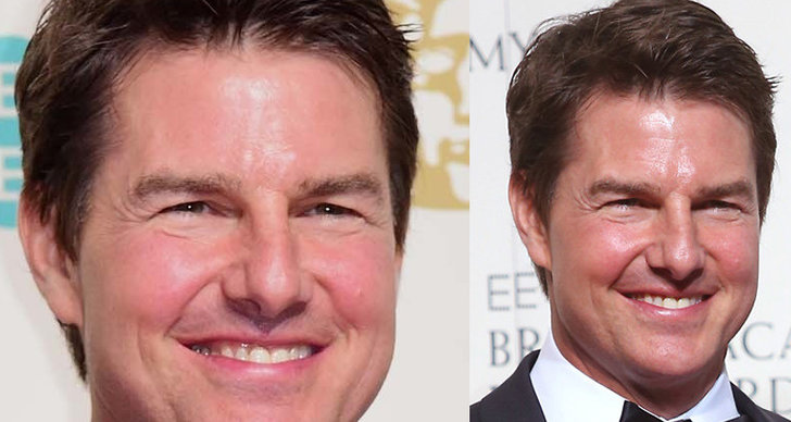 Operationer, Tom Cruise, Fillers, Kirurgi, Botox, Bafta Awards