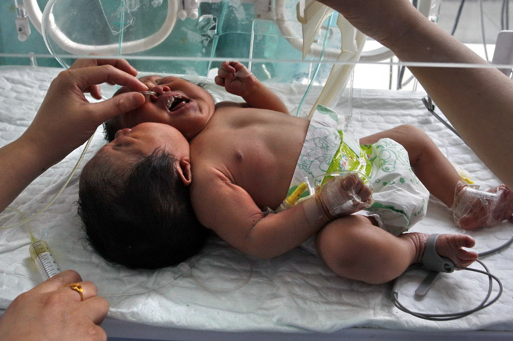 Brasilien, Barn, Bebis, Siamesiska tvillingar