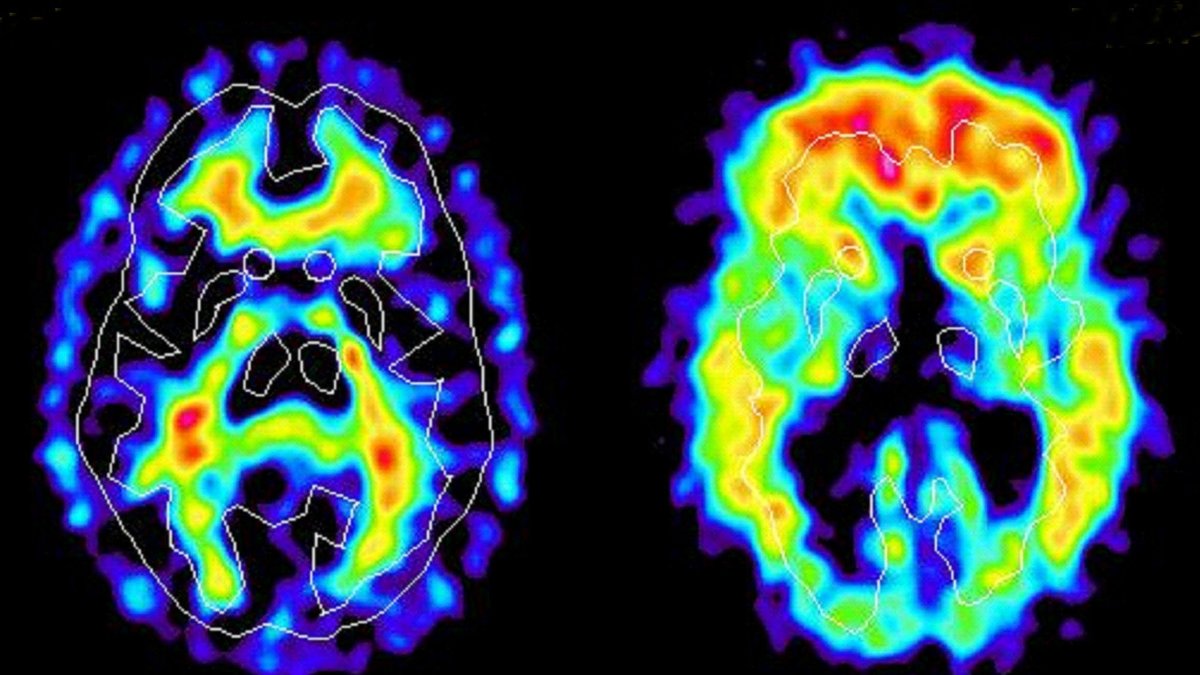 Upptäckten kan får betydelse för forskning om alzheimers.