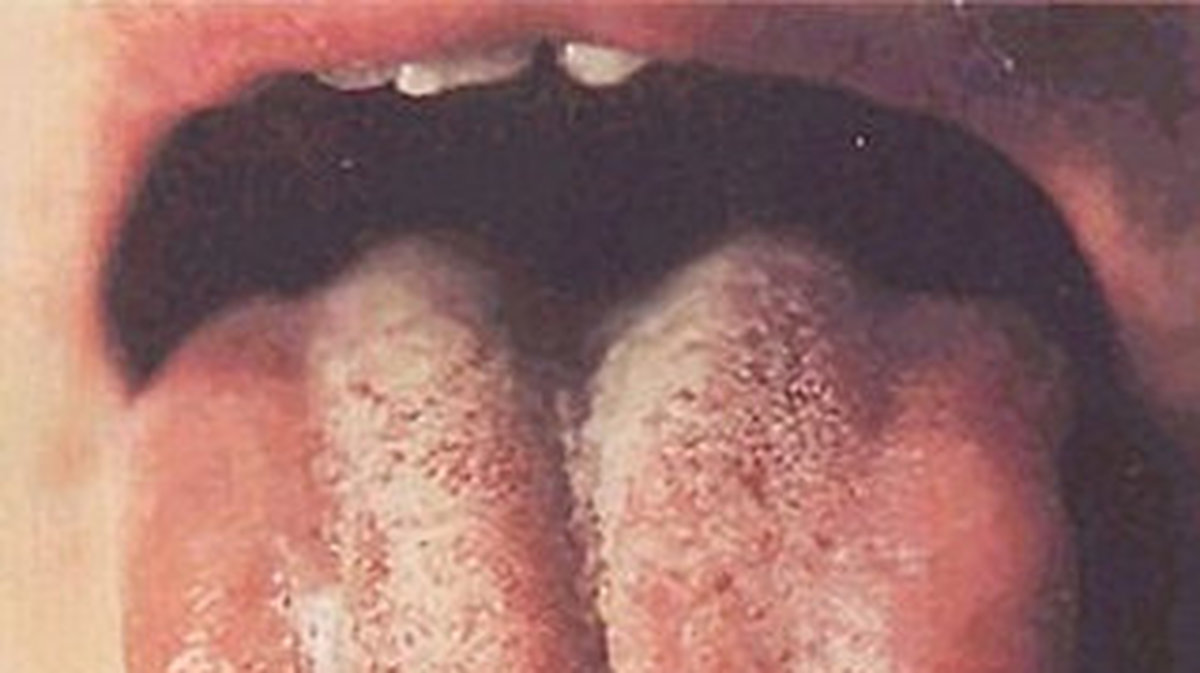 En splittrad tunga kan leda till dålig andedräkt då bakterier gillar miljöer där de kan gömma sig i skåror. 