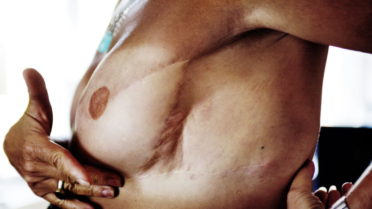 En kvinna som har opererat sitt bröst.