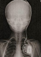 Röntgenbild på batteriet i Robbies bröst som skickar meddelanden till hans hjärna.