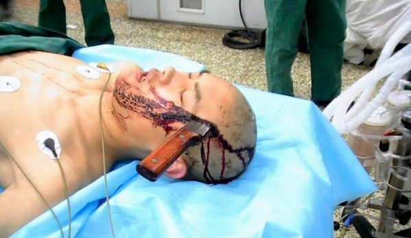 Xiao Wei överlevde mirakulöst knivattacken.