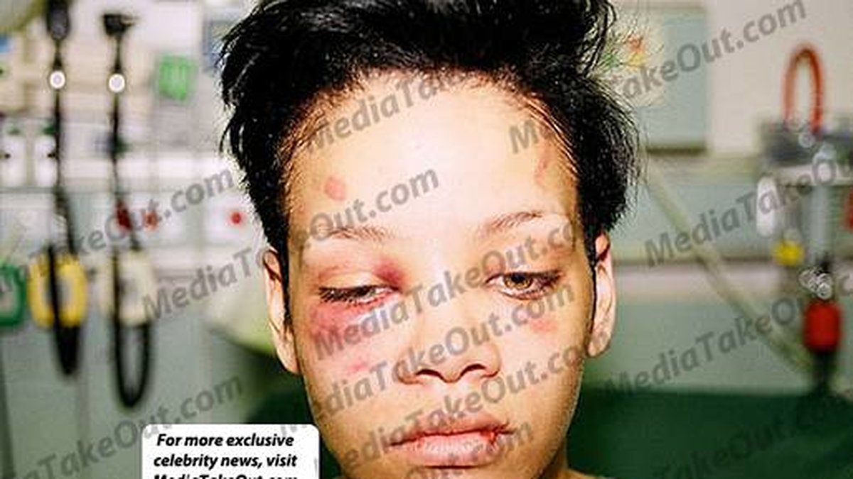 Så här såg Rihannas brutala skador ut år 2009 efter att hon hade blivit utsatt för en brutal misshandel av Chris Brown.
