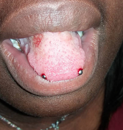 piercing i tungan risker piercing i tungan risker