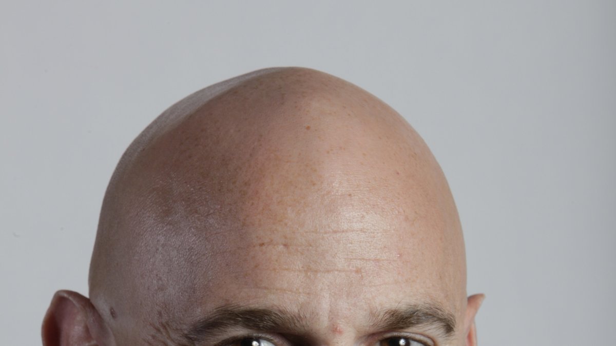 Alopecia är en autoimmun sjukdom som gör att man tappar hår.