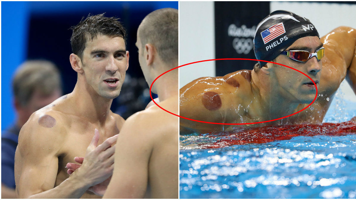 Michael Phelps har synts med stora blåmärken på sin kropp. 