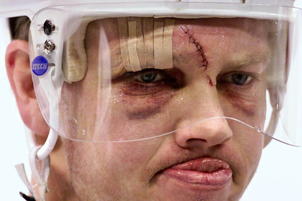 Ishockey är förhållandevis skadefritt, men när det sker, så blir det ofta en fråga om allvarligare nack- och hjärnskador.
