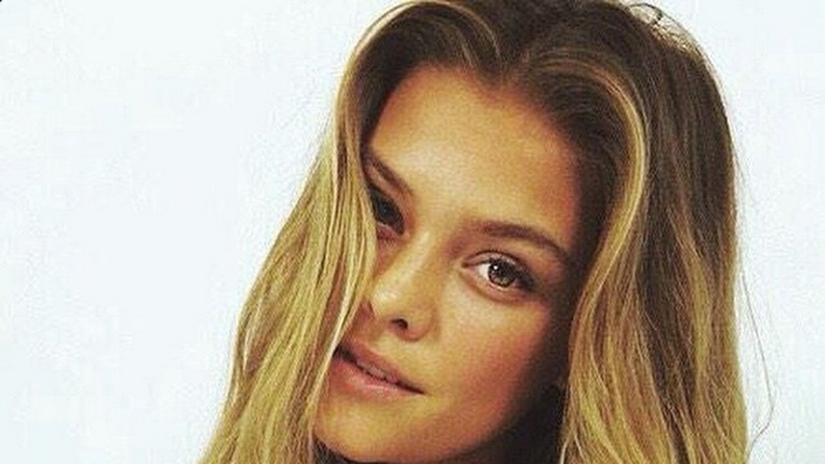 Danska supermodellen Nina Agdal visade upp sin brända hud på Instagram.