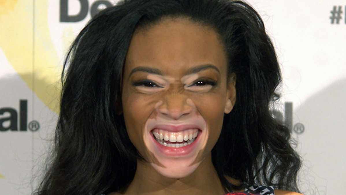 Winnie Harlow har hudsjukdomen vitiligo. Vitiligo innebär ett bortfall av pigmentering i huden vilket gör att huden blir vit. Winnie har bland annat varit med i Top Model, dessutom var hon med italienska Diesels vårkampanj,