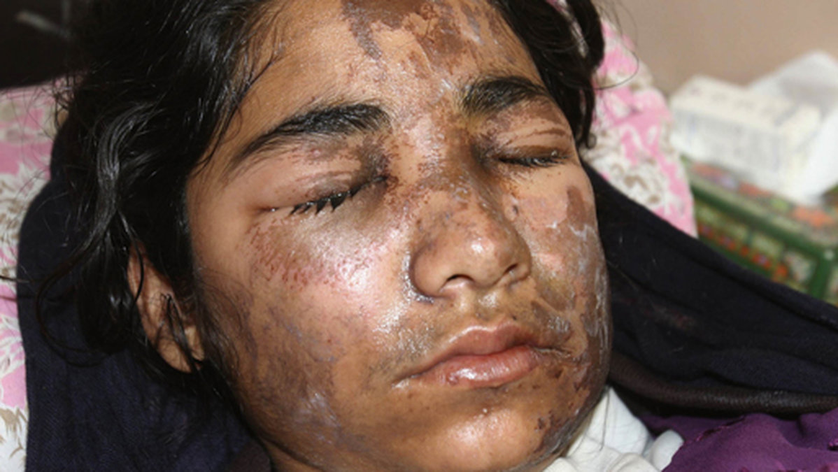 17-åriga Shamsia Husainai blev utsatt för en syraattack 2008. Män på motorcykel sprejade hennes ansikte med syra när hon var på väg till skolan. 