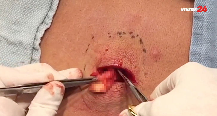 Pimple Popper, Operation