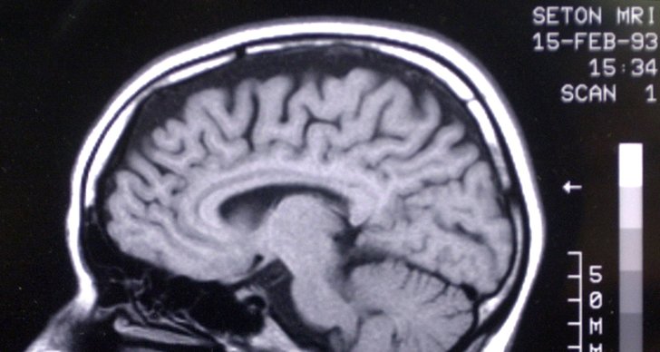 fMRI, Forskning, Koma, Hjärnan