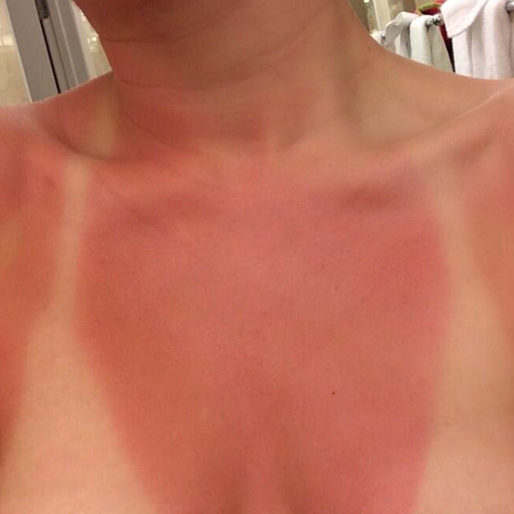 Miley brände sig illa i Floridas heta sol. Miley brände sig illa i Floridas heta sol.