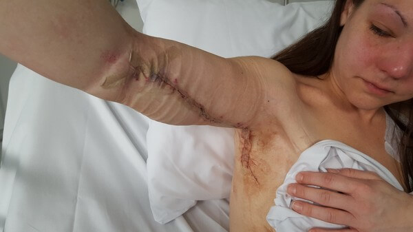 De första bilderna efter operationen. Det syns hur ont hon har.