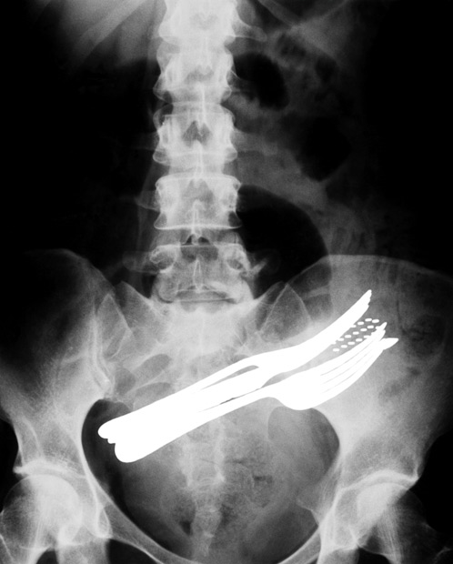 Den här patienten har av någon anledning svalt två gafflar, en kulspetspenna och en tandborste. Den här patienten har av någon anledning svalt två gafflar, en kulspetspenna och en tandborste.