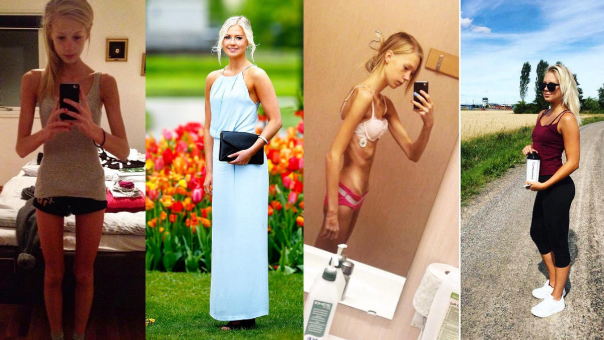 Cazandra Zetterberg, 19, har varit frisk från anorexia i ett år. 
