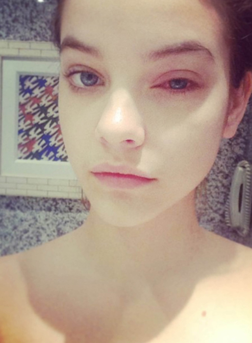 Barbara Palvin kan inte jobba eftersom hon åkt på en ruggig ögoninflammation. Barbara Palvin kan inte jobba eftersom hon åkt på en ruggig ögoninflammation.