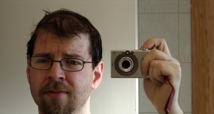 har jag haft vattkoppor har jag haft vattkoppor