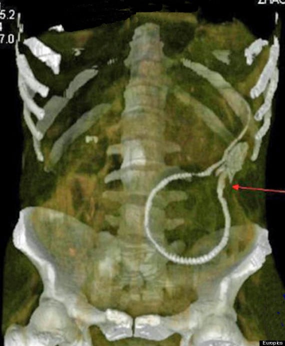 En avslöjande röntgenbild av ålen i magen. 