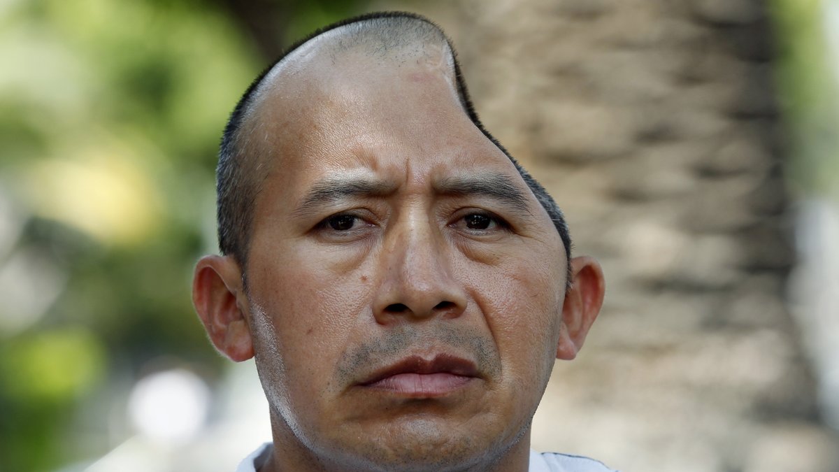 Antonio Lopez Chaj förlorade en tredjedel av sin skalle när han misshandlades.