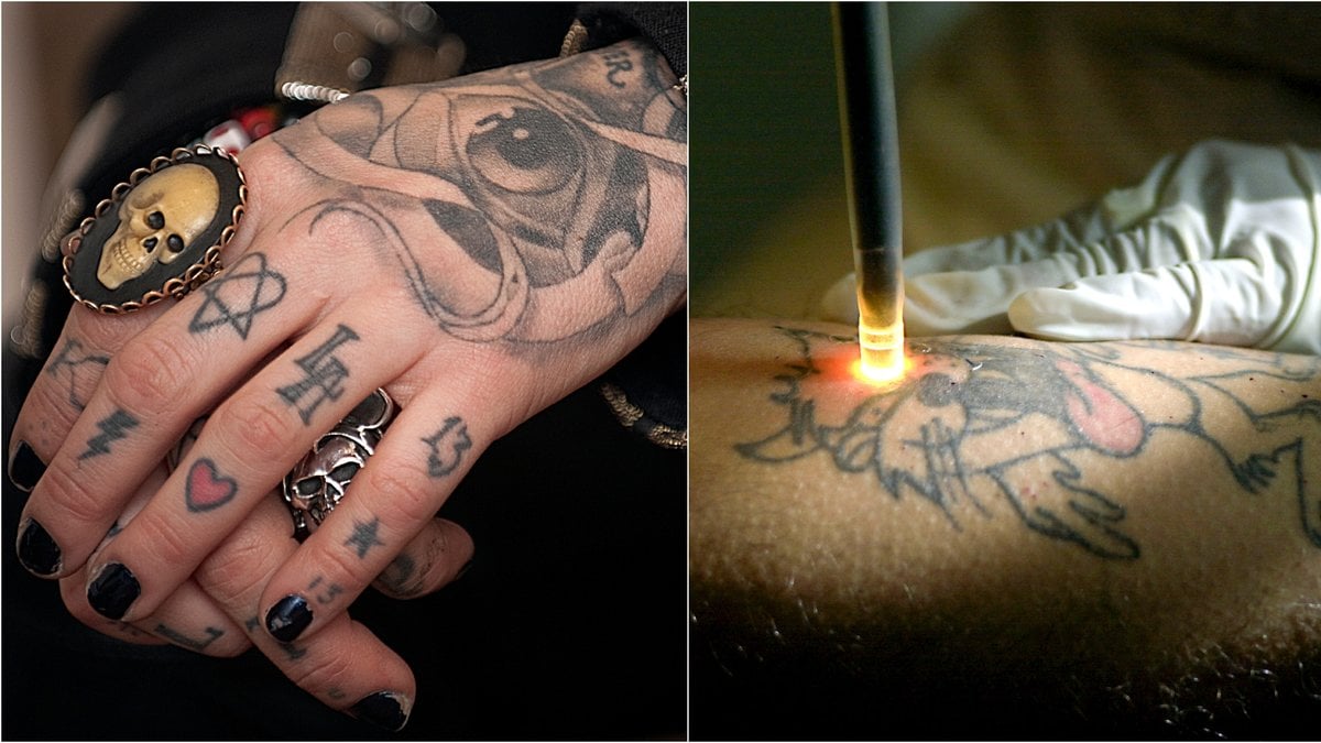Det blir allt vanligare att vilja använda laserborttagning för att bli kvitt tatueringar. 