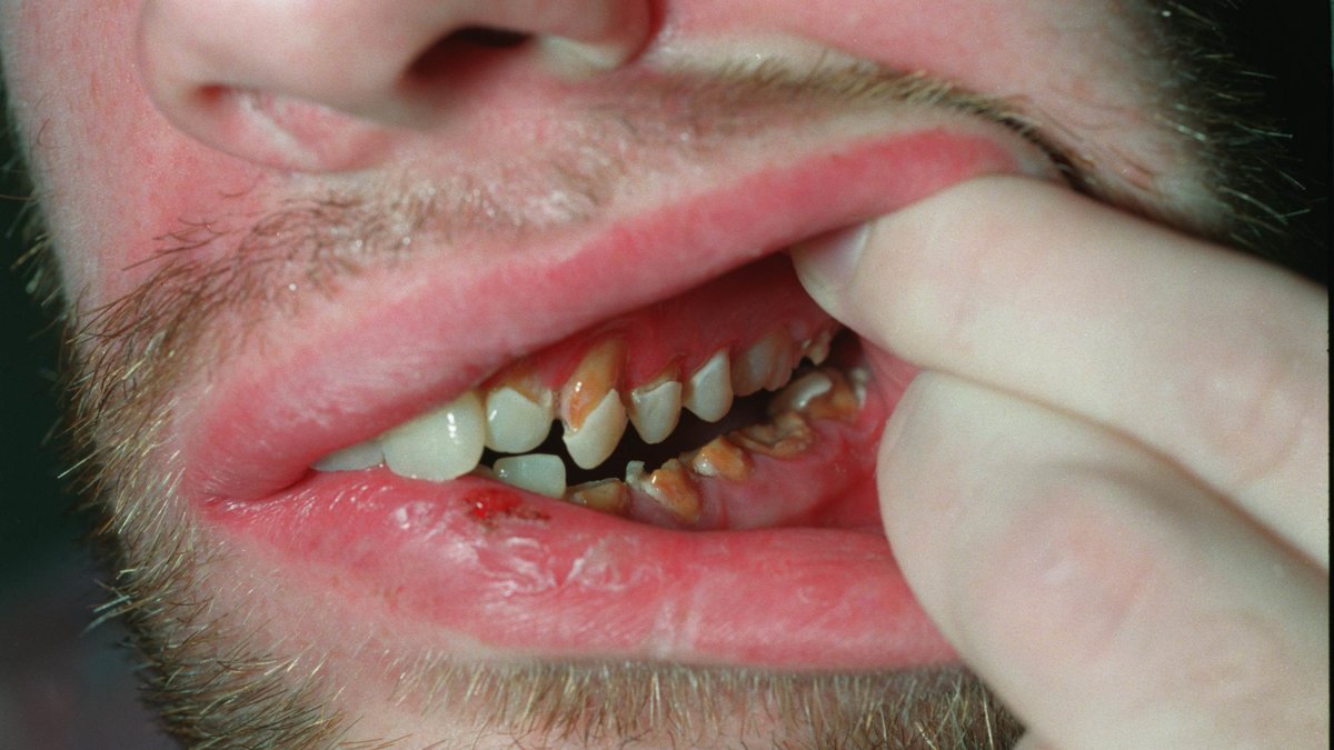 Forskare hoppas att man i framtiden ska kunna ersätta dåliga tänder.